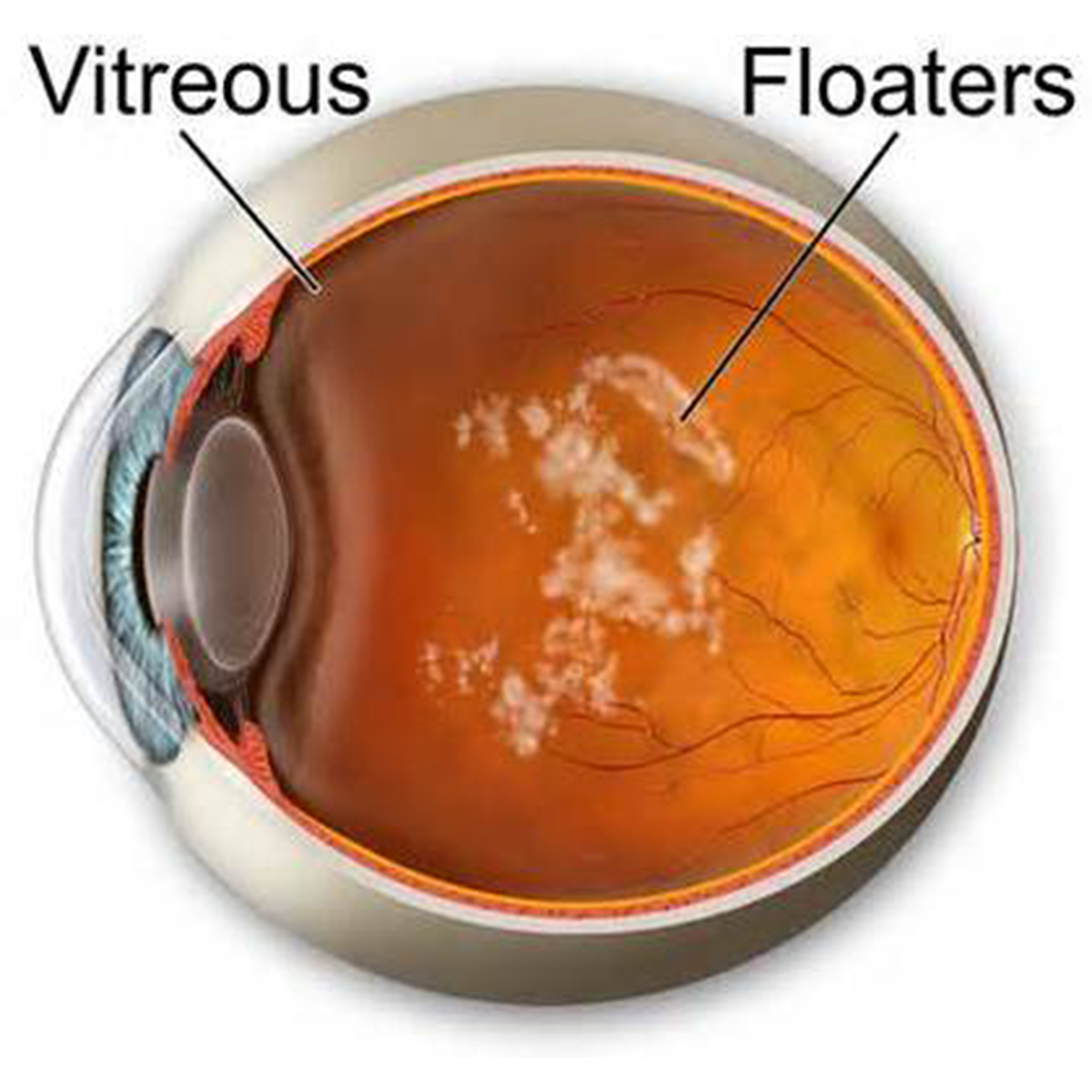 What is Myopia?